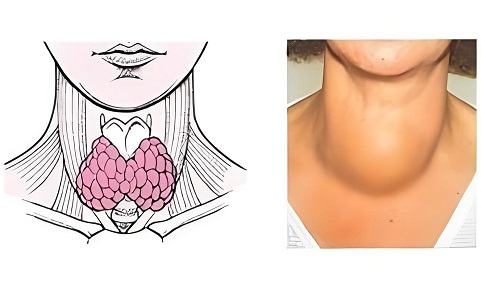 女性甲亢最明显的症状